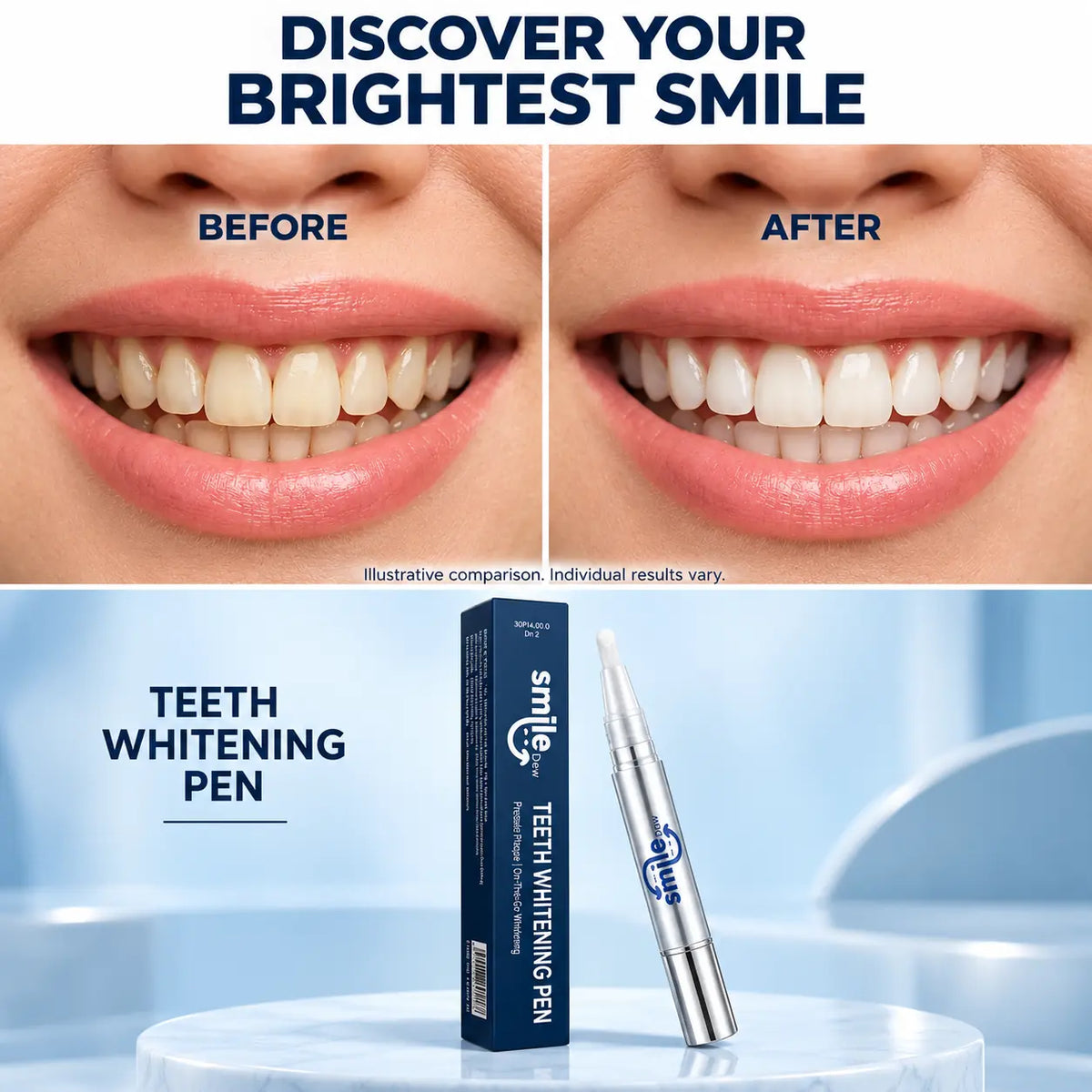 Before and after smile comparison using Smile Dew peroxide-free teeth whitening pen, individual results vary.
